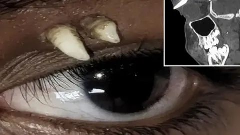 Doktorlar şokta: 16 yaşındaki çocuğun gözünde diş büyüdü