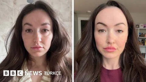 'Ferritin yüzü': Demir eksikliği dış görünüşten anlaşılabilir mi?