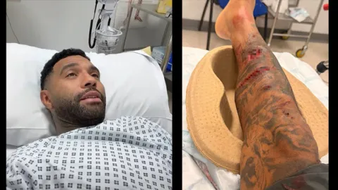 Liverpool'un eski yıldızı Jermaine Pennant'a köpek saldırdı! Bacağına 50 dikiş atıldı