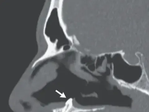 Doktorlar şokta: 16 yaşındaki çocuğun gözünde diş büyüdü - fotoğraf 4