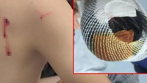 Okul dönüşü köpeklerin saldırdığı çocuğun başına 15 dikiş atıldı