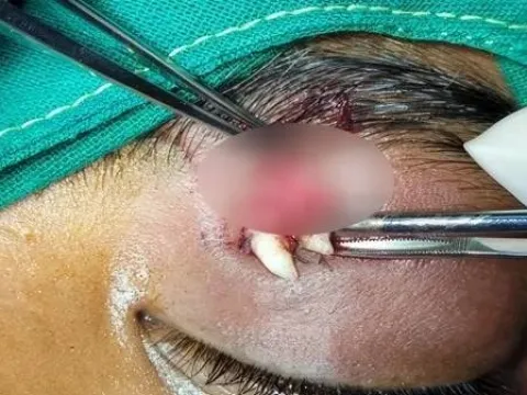 Doktorlar şokta: 16 yaşındaki çocuğun gözünde diş büyüdü - fotoğraf 3