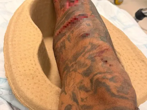 Liverpool'un eski yıldızı Jermaine Pennant'a köpek saldırdı! Bacağına 50 dikiş atıldı - fotoğraf 4