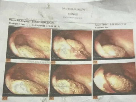 Ameliyatta unutulan gazlı bez bağırsaklarını delmişti: 2 doktora hapis istemiyle dava - fotoğraf 3
